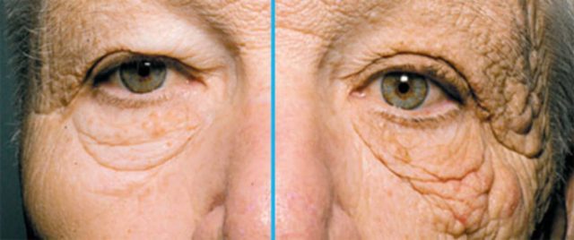 皮膚の老化について